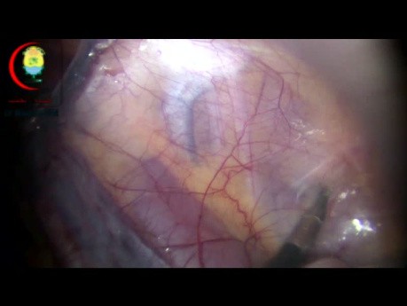 Laparoscopic Anatomy of Groin Hernia
