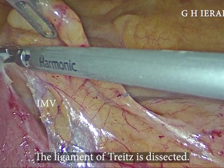 Laparoscopic Left Colectomy for Splenic Flexure Carcinoma with Preservation of the IMA: Our Technique Step by Step