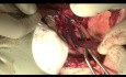Pulmonary Artery Xenograft Patch During a Double Sleeve Left Upper Lobectomy for NSCLC