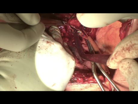 Pulmonary Artery Xenograft Patch During a Double Sleeve Left Upper Lobectomy for NSCLC