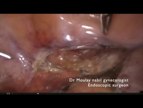Hysterectomy for residents . Full edition