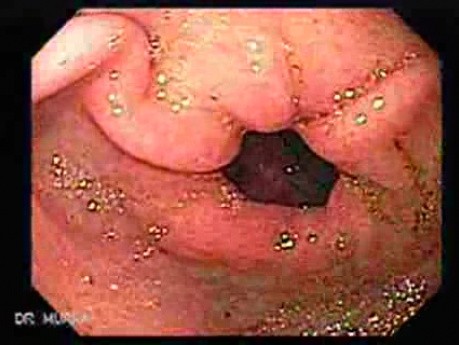 Stomach Cancer (1 of 2)
