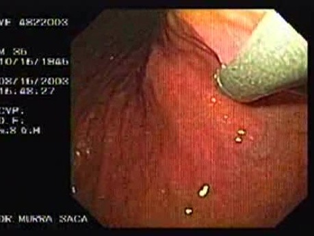 Flexible Endoscopic Suturing Device, Part 2