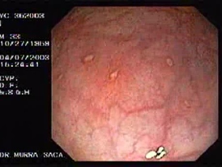 Endoscopic View of Amebiasis Colitis (2 of 7)
