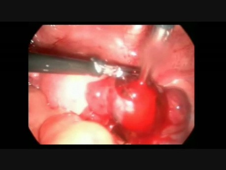 Laparoscopic Salpingostomy Due to EP