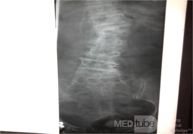Fracture Compressions L1 With Spondiloarthrosis
