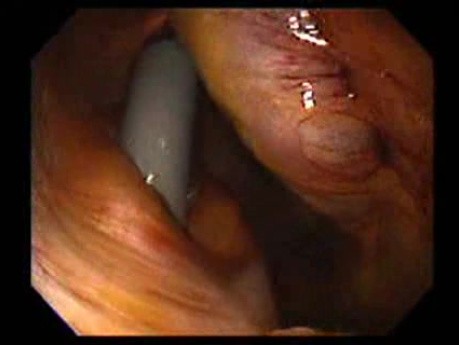 Gastrointestinal Stromal Tumor - GIST (33 of 65)
