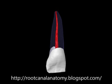 Maxillary Lateral Incisor