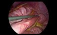 Hybrid Technique (Toupet & OAGBP)