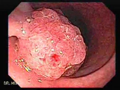 Large Tubulo-Villous Adenoma (3 of 6)