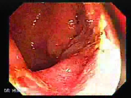 Ascending Colon Cancer (2 of 6)