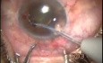 Neovascular Glaucoma - Transciliary Filtration