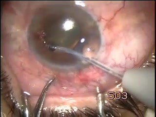 Neovascular Glaucoma - Transciliary Filtration