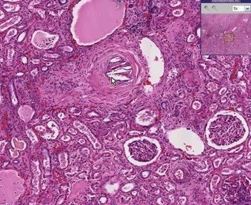 Kidney - Atheroemboli