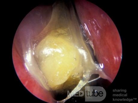 ASA Triad Thick Yellow Mucus