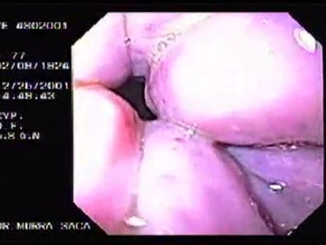 Hemorrhage due status post rubber band ligation of esophageal varices (1 of 25)