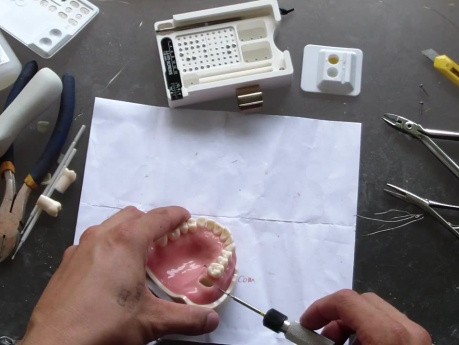 Molar Intrusion - Table Top How To - Part 1/2