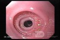 Congenital Esophageal Rings - Endoscopic Assessment of the Esophagus, Part 1
