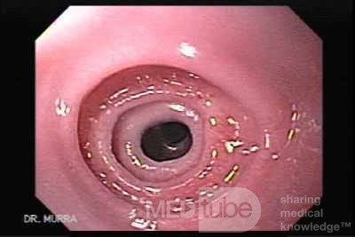 Congenital Esophageal Rings - Endoscopic Assessment of the Esophagus, Part 1