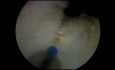 Holep with Incision of Prostatic Abcess