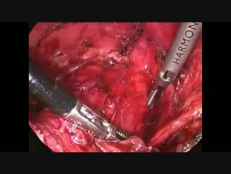 Laparoscopic Anterior Mesh Rectopexy