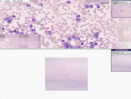 Blood - Chronic Myelogenous Leukemia