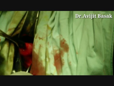 Cervical Cerclage Mc'Donalds procedure by Dr.Avijit Basak