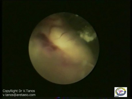 Hysteroscopy