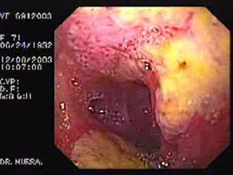 Mirror Ulcers of the Duodenum