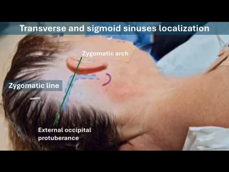 Localizing Transverse and Sigmoid Sinuses