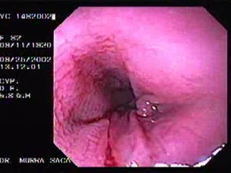 Colon Sigmoid Perforation (3 of 4)