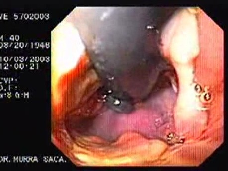 Acute Variceal Bleeding - Status Post Final Banding