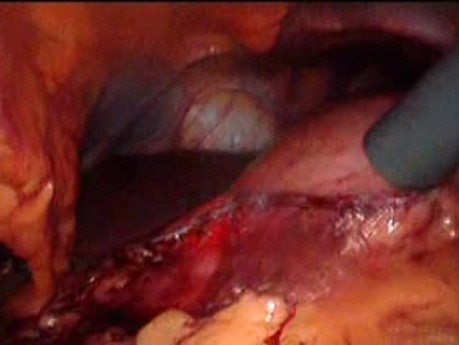 Gastrointestinal Stromal Tumor - GIST (51 of 65)