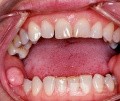 Fibroepithelial Polyp Oral Mucosa