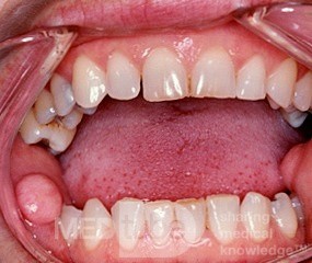 Fibroepithelial Polyp Oral Mucosa