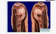 Osteosarcoma - Histopathology - Bone