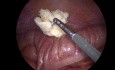 Laparoscopic Loop Colostomy for Large Bowel Obstruction