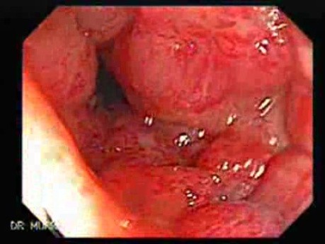 Post-Radiation Colitis (1 of 13)