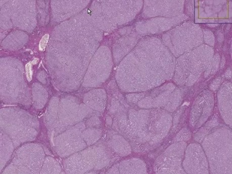 Alpha-1-antitrypsin deficiency