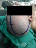 Acute Spontaneous Subdural Hemorrhage in the Subdural Space