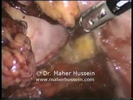 Total mesorectal resection coloanal anastomosis - Laparoscopy