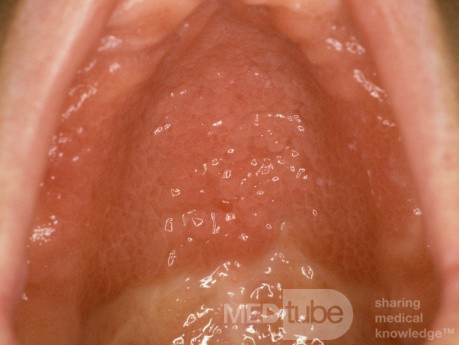 Allergic Reaction To Denture