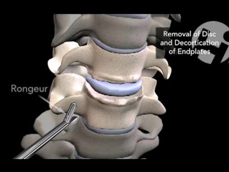 Anterior Discectomy and Interbody Fusion