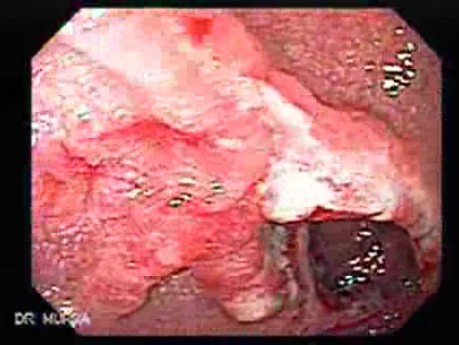 Multiple Adenomatous Polyps Of The Rectum (16 of 37)