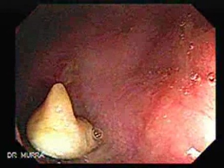 Status Post Rubber Band Ligation for Internal Hemorrhoids (1 of 7)