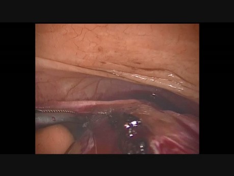 Anexectomy Teratoma