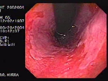Barrett's Esophagus of long segment retroflexed view (3 of 24)