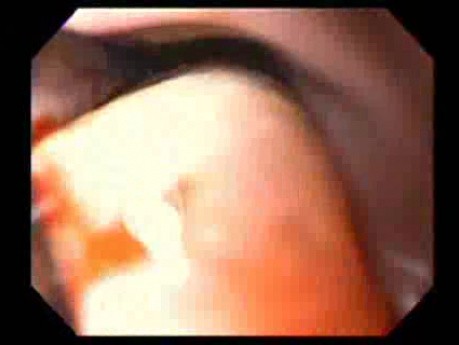 Massive Epistaxis - 76-year-old female patient - 5/8