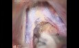 Pineal Tumor Surgery - Subtentorial Supracerebellar Approach