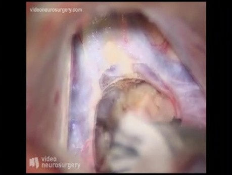 Pineal Tumor Surgery - Subtentorial Supracerebellar Approach